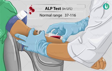 Alkaline Phosphatase (ALP) Test: Procedure, Purpose, Results, Normal ...