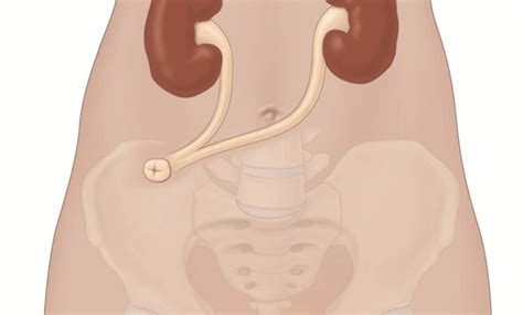 Ureterostomy: A Comprehensive Guide to Understanding the Procedure