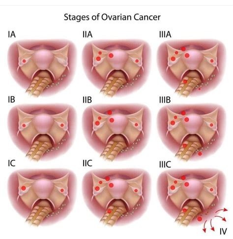 grade 3 c i was diagnosed. most are detected late stage know the ...