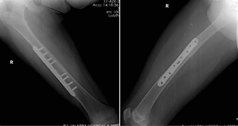 Cureus | Treatment of Diaphyseal Fractures of the Femur in Paediatric Age Group: A Comparative ...