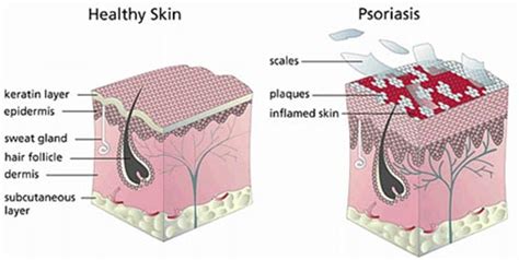 Psoriasis Treatment Specialist · 2021 Top Laser Dermatologist NYC