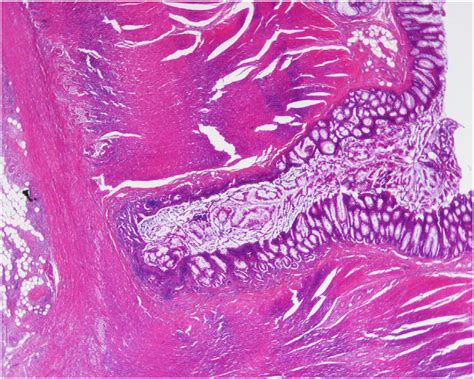 The histological examination of the resected specimen showed... | Download Scientific Diagram