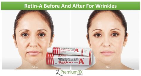 Retin-A Before And After For Wrinkles | PremiumRx- Online Pharmacy