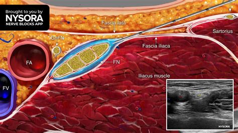 Tips for a Femoral Nerve Block - NYSORA | NYSORA