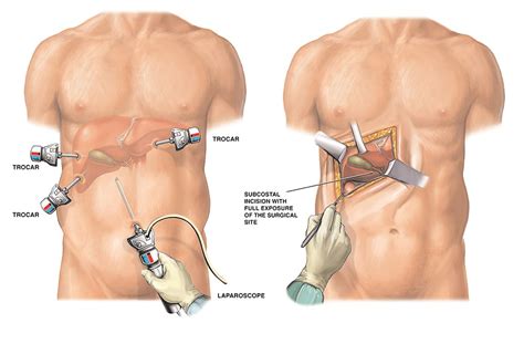 Laparoscopic Cholecystectomy Injury | Zayed Law Offices