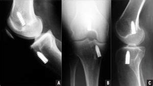 After ACL Reconstruction: Complication and post-surgery treatment options: Do you need revision ...