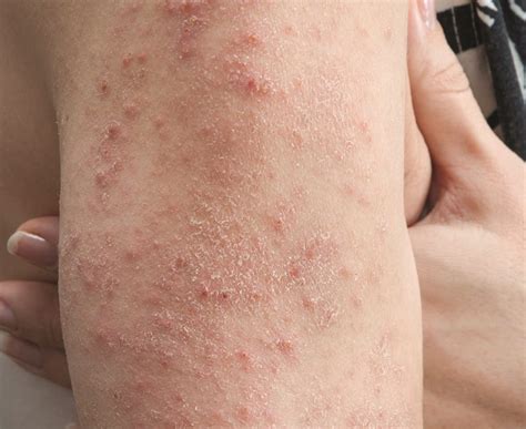 Celiac That's Skin Deep: The Mysterious Rash Sparked by Gluten