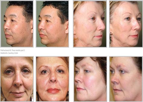 Before and After - Renew Stem Cell and Laser