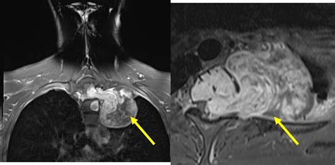 Spinal schwannoma – Radiology Cases