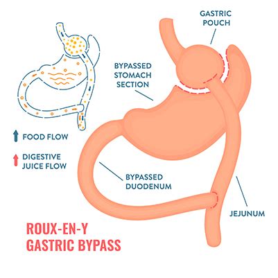 Gastric Bypass Surgery - CHRISTUS Health