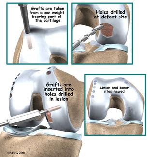 Articular Cartilage Transplant | Knee Doctor near Seattle WA