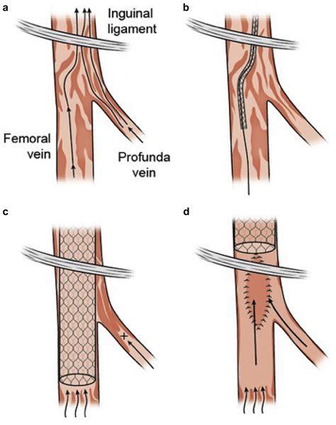 Common femoral endovenectomy in conjunction with iliac vein stenting to improve venous inflow in ...