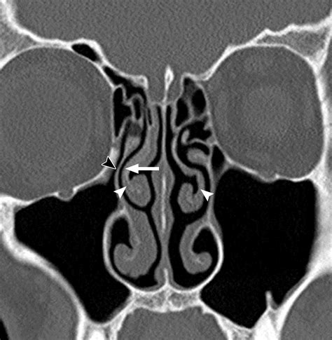 The Preoperative Sinus CT: Avoiding a “CLOSE” Call with Surgical ...