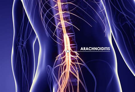 Herbal Remedies for Arachnoiditis with Ayurveda - Planet Ayurveda