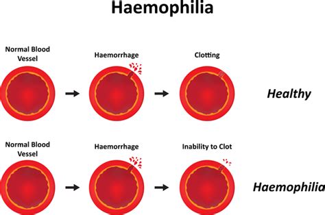 Hemophilia Nursing Care Planning and Management Study Guide - Nurseslabs