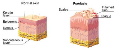 Scalp Psoriasis Treatment · 2021 Top Dermatology · Dermatologist NYC