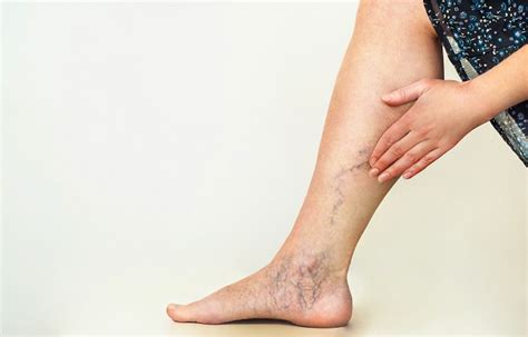 Varicose Veins During Pregnancy - Torontek