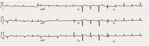 Pericardial Diseases | Thoracic Key