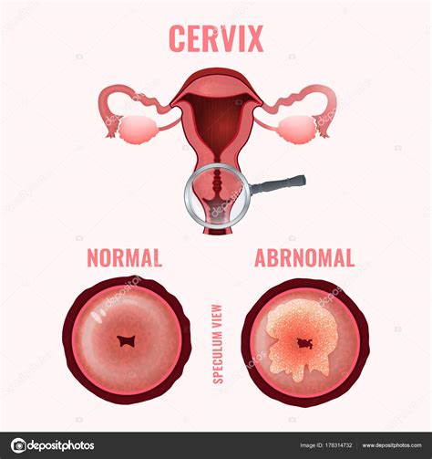 Cervical cancer image Stock Vector by ©annyart 178314732