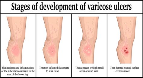 Leg Ulcer Treatment