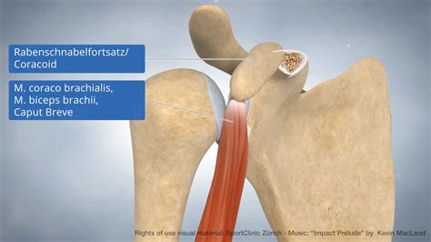 Animation Latarjet procedure - MedicalGraphics