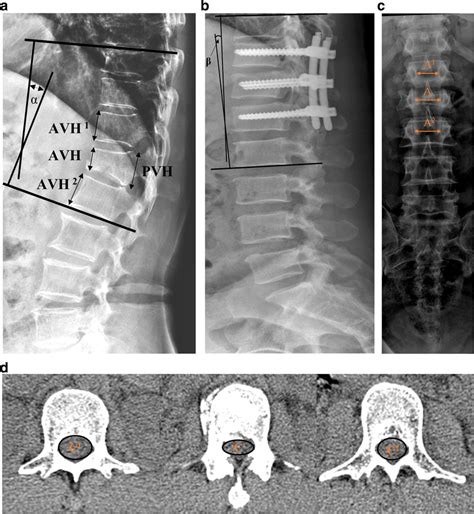 a, b the preoperative Cobb angle and surgically corrected Cobb angle... | Download Scientific ...