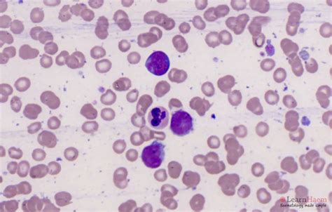 Mantle Cell Lymphoma - LearnHaem | Haematology Made Simple