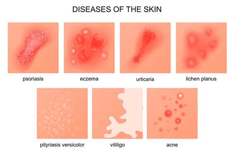 Differences between eczema and psoriasis