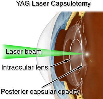 YAG Laser Capsulotomy - NewView Eye Center - NewView Eye Center