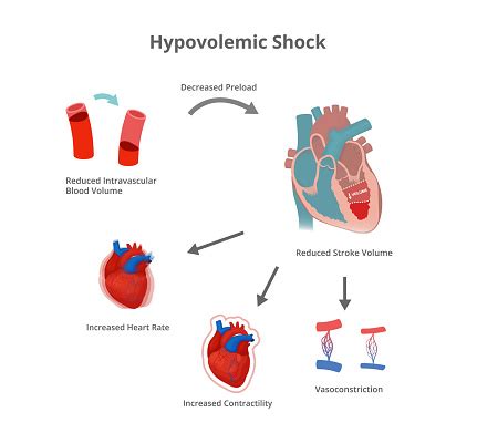 what is hypovolemic thirst