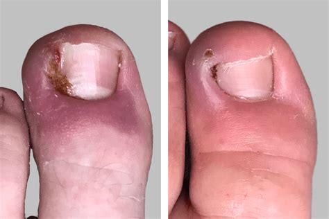 Before and After Photos | Akron Podiatrist | Dr. Nicholas Campitelli ...