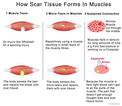 How Scar Tissue Forms In Muscles Infographic | Massage Therapy and ...