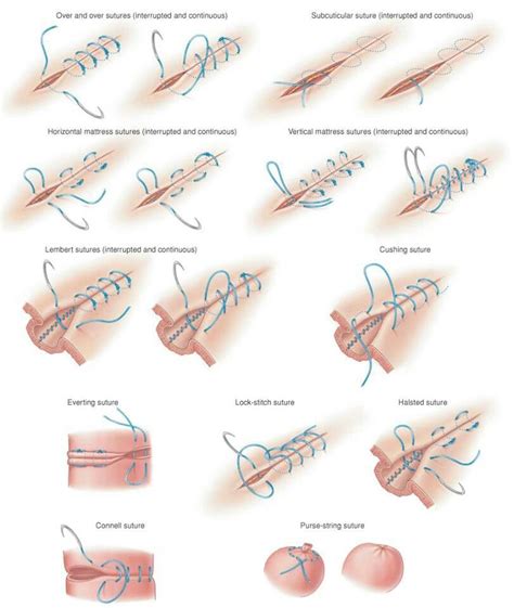 SurvivalGearup: How to suture a wound in an emergency