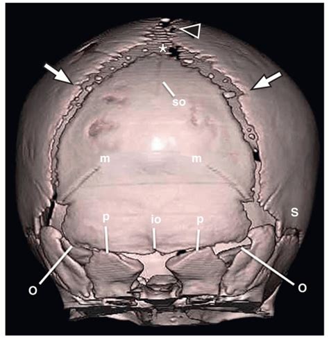 Skull | Radiology Key