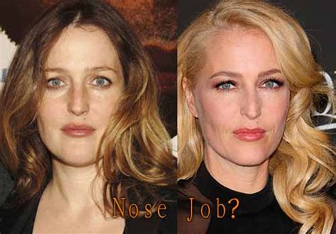 Gillian Anderson Plastic Surgery - Top Celebrity Surgery