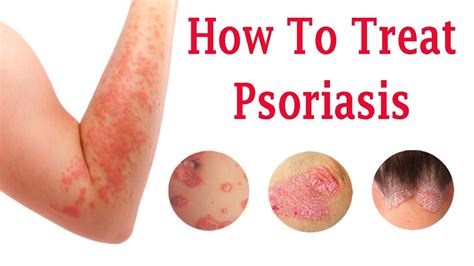 Do You Know About The Causes Of Psoriasis And How To Treat Psoriasis? See This Video - YouTube