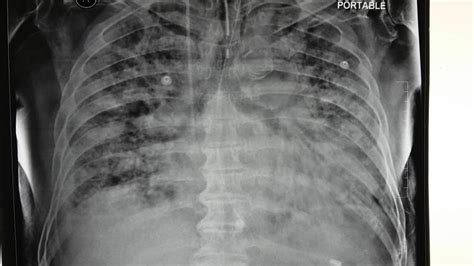 Acute Respiratory Distress Syndrome CXR - YouTube