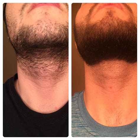 Minoxidil Beard Before And After