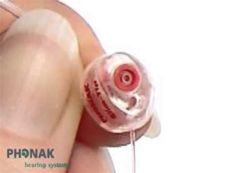 Changing the open domes and slim tips on Phonak slim tube hearing aids ...