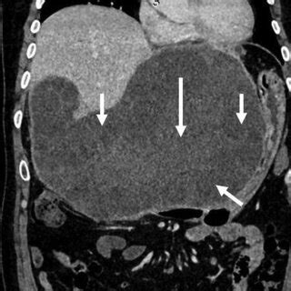 Hydatid cyst: Ultrasound. Multiple stages of hydatid cyst are shown ...