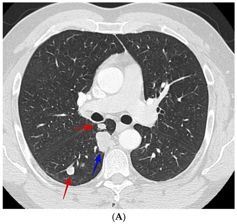 JoF | Free Full-Text | Differentiating Lung Nodules Due to Coccidioides from Those Due to Lung ...