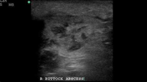 POCUS - Soft Tissue Ultrasound - Abscess - YouTube