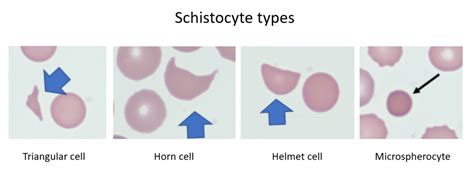 What are the different kinds of schistocytes? • The Blood Project