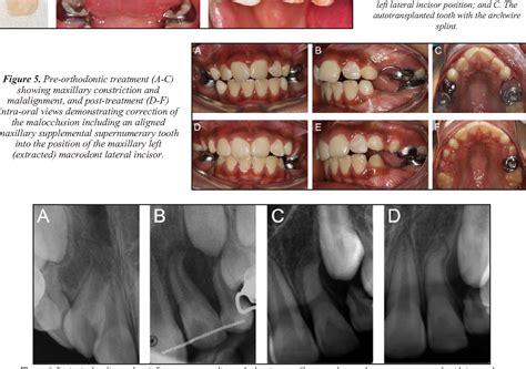 Figure 5 from Autotransplantation as a Treatment Modality of Macrodontia: A Case Report ...