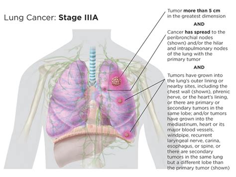 Stage 2 Of Lung Cancer