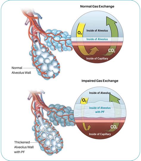 Diagnosis | Pulmonary Fibrosis Foundation