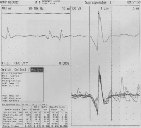 Recovery After Epidural Blood Patch download free - globalbittorrent