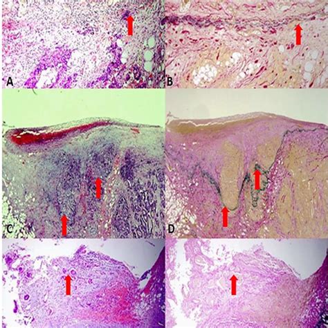 A:Tumor cells approached the serosa, as shown by the red arrow (H&E ...