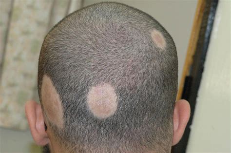 ringworm in hair - pictures, photos