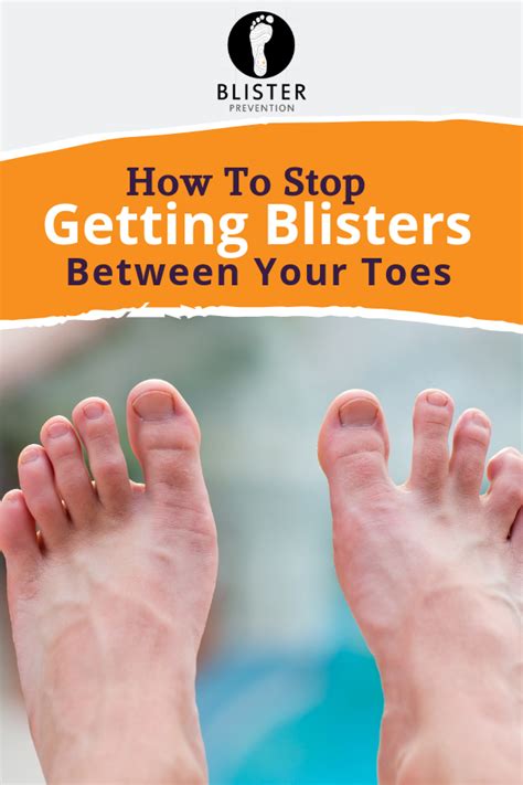 Blisters Between Toes: 7 Expert Ways To Prevent | Blisters, Toes, Prevention